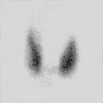 Quist de tiroide - malalties de la tiroide